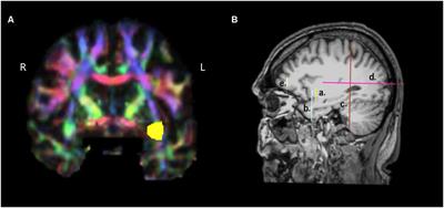 The Role of the Right Hemisphere White Matter Tracts in Chronic Aphasic Patients After Damage of the Language Tracts in the Left Hemisphere